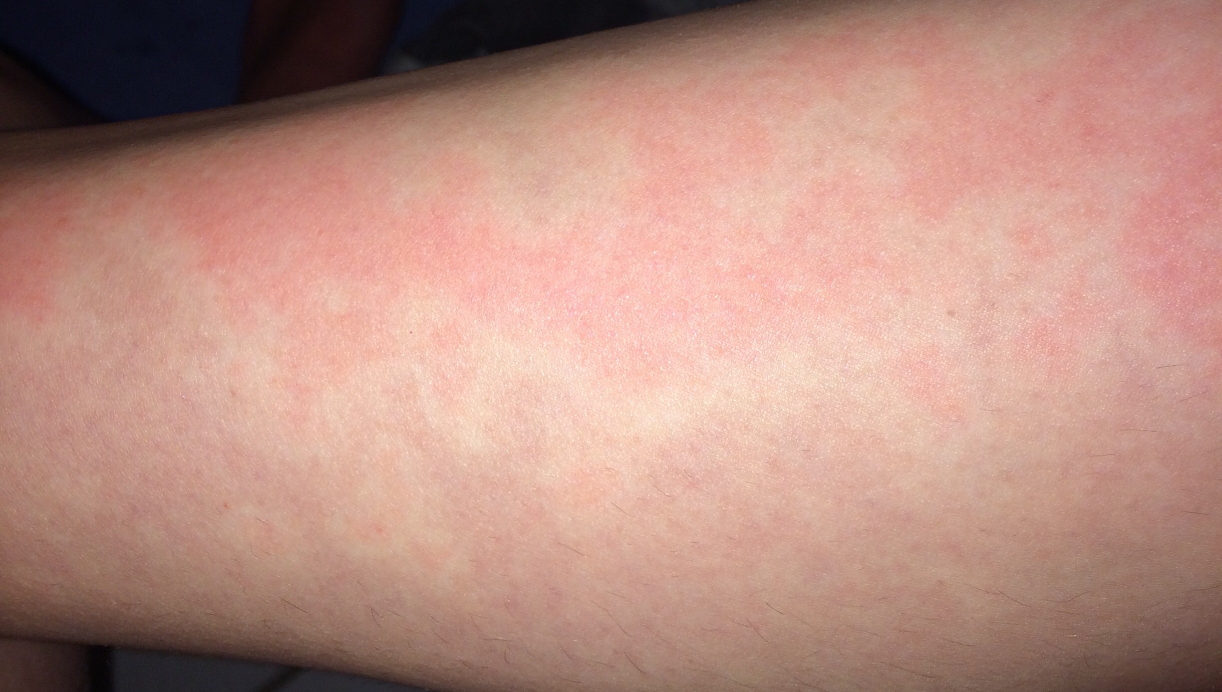 Was habe ich da für rote Flecken auf der Haut? (Gesundheit, Medizin Was habe ich da für rote Flecken auf der Haut? (Gesundheit, Medizin