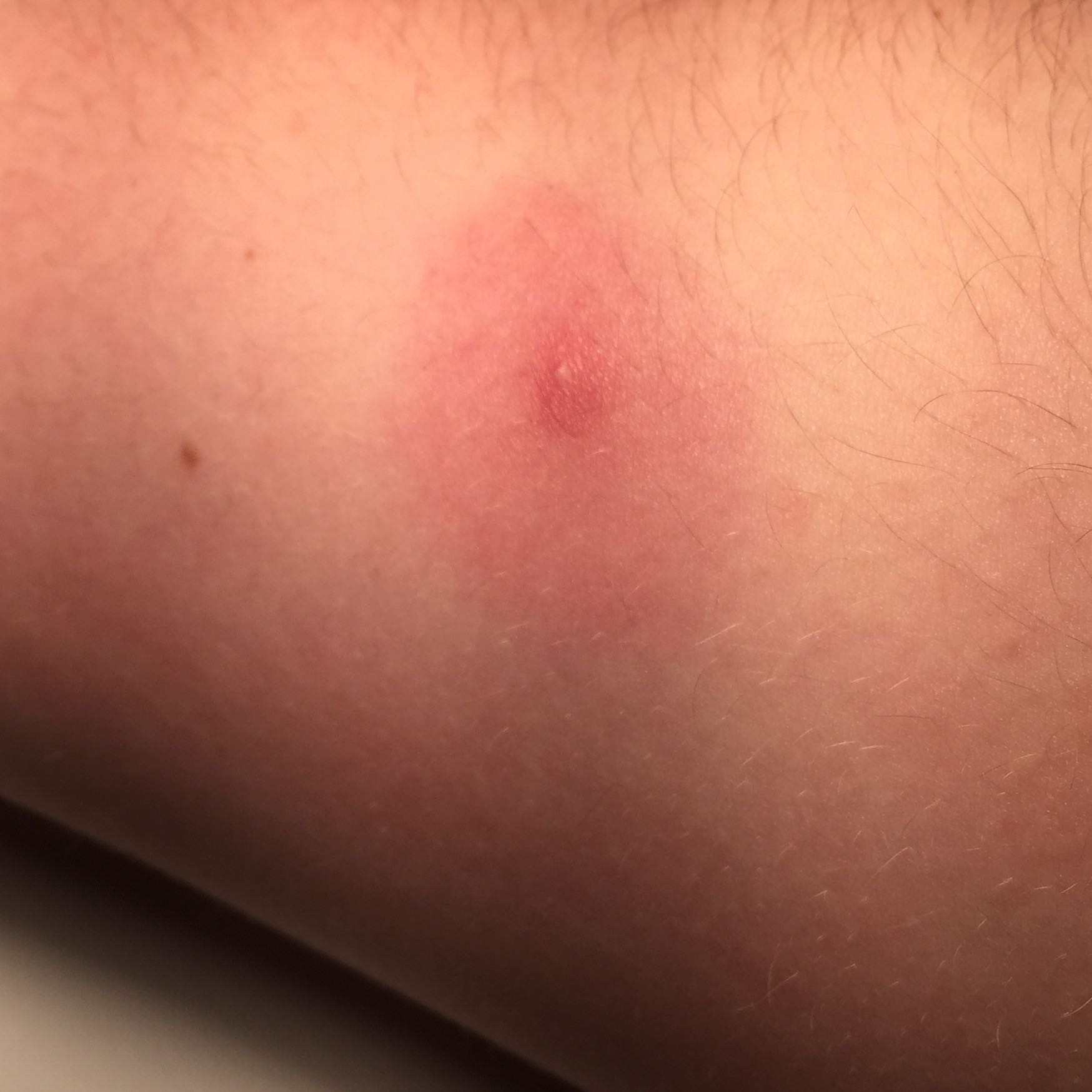 Was habe ich fürein roten fleck am Arm? (Arzt, Männer, Haut) Was habe ich fürein roten fleck am Arm? (Arzt, Männer, Haut)