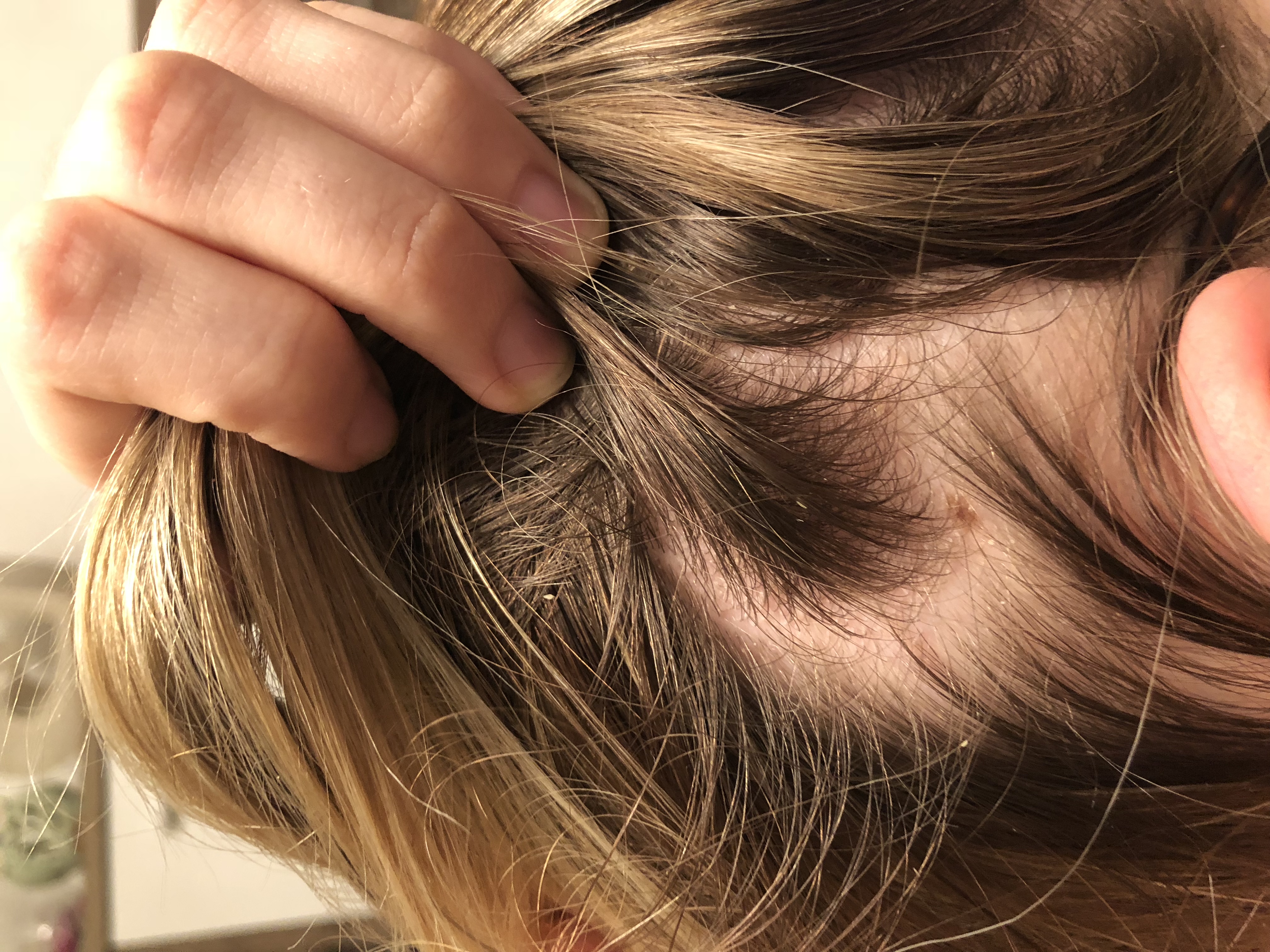 Was habe ich? Hautkrankheit oder Läuse? (Gesundheit und Medizin