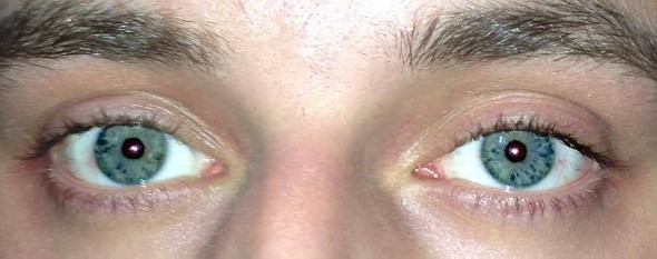 Hepatitis b augen,Was Haben Meine Augen Wieso Sind Sie Nicht Klar Weiss Ernahrung Arzt Krankheit
