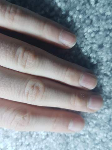 Was Haben Meine Fingernagel Fur Rillen Krankheit