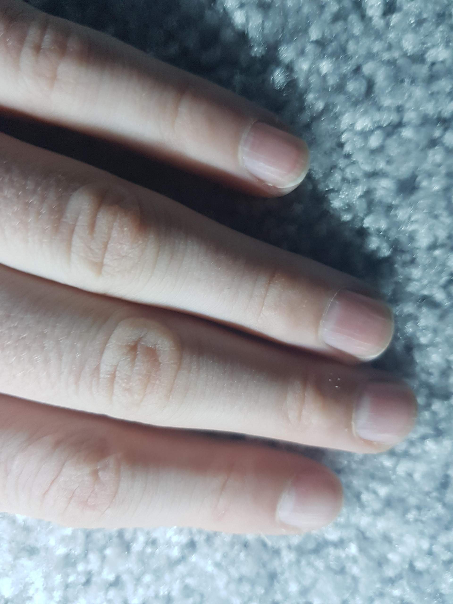 Finger Innen Rillen Was haben meine Fingernägel für Rillen? (Krankheit)