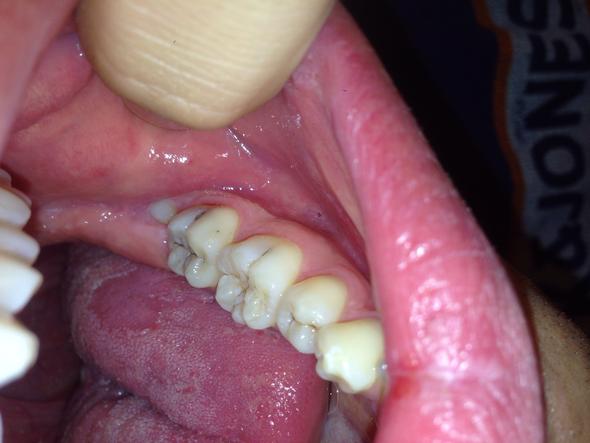 Schwarze Flecken und Weisheitszahn hinten - (Zähne, Zahnarzt)