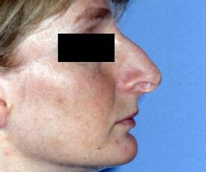 Was Haltet Ihr Von Solchem Kinn Bei Einer Frau Frauen Schonheit Schonheits Op