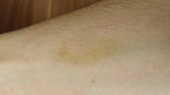 Was hat dieser Gelbe Fleck zu bedeuten? (Medikamente, gelb, Vomacur)