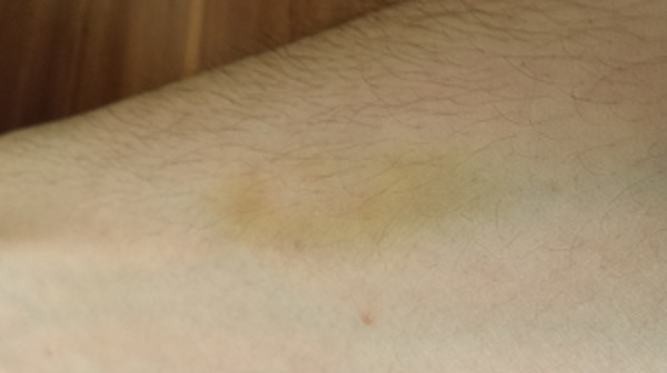 Was hat dieser Gelbe Fleck zu bedeuten? (Medikamente, gelb, Vomacur)