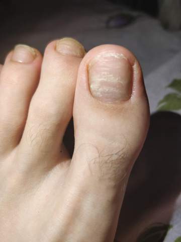 Was Hat Es Mit Meinem Zehennagel Auf Sich Gesundheit Zehennagel Was Hat Es Mit Meinem Zehennagel Auf Sich Gesundheit Zehennagel