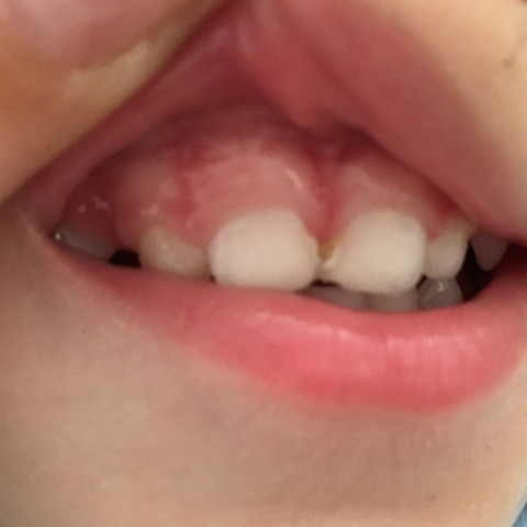 Zwichen den beiden oberen Zähnen  - (Kinder, Zähne)
