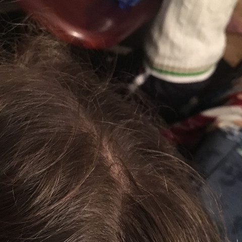 was hat meine tochter haarausfall