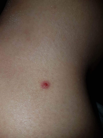 Was Hat Mich Gestochen Was Ist Das Fur Ein Roter Fleck Auf Meiner Haut Insektenstich Was Hat Mich Gestochen Was Ist Das Fur Ein Roter Fleck Auf Meiner Haut Insektenstich