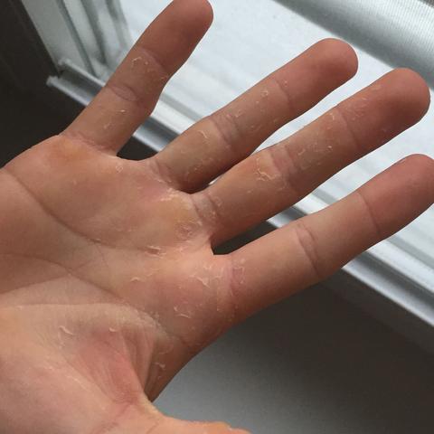 Was Hilft Gegen Diese Blasen Hand Was Hilft Gegen Diese Blasen Hand