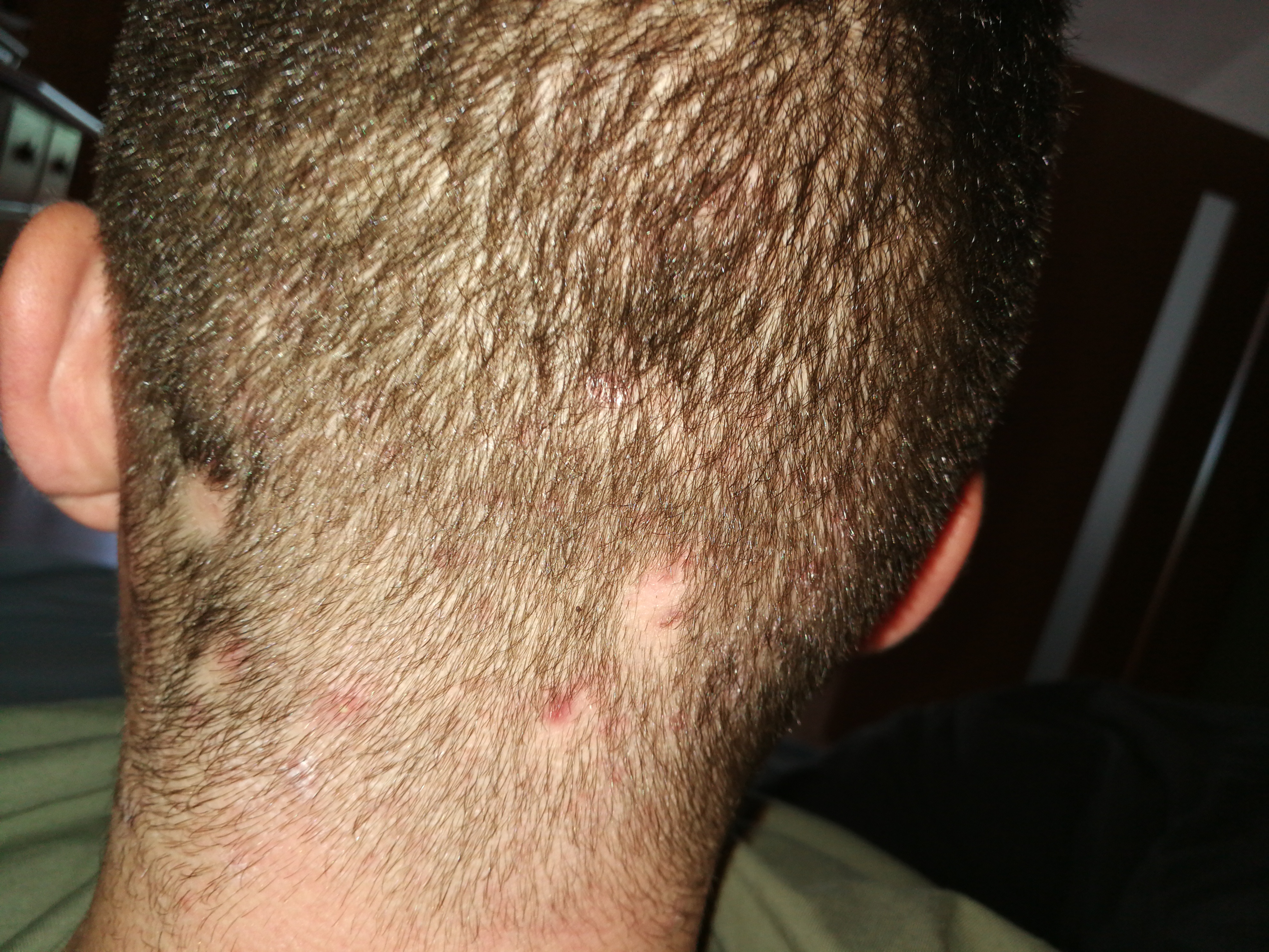Was Hilft Gegen Eine Kahle Stelle Am Hinterkopf Nach Pickel Gesundheit Und Medizin Akne Haarausfall Was Hilft Gegen Eine Kahle Stelle Am Hinterkopf Nach Pickel Gesundheit Und Medizin Akne Haarausfall