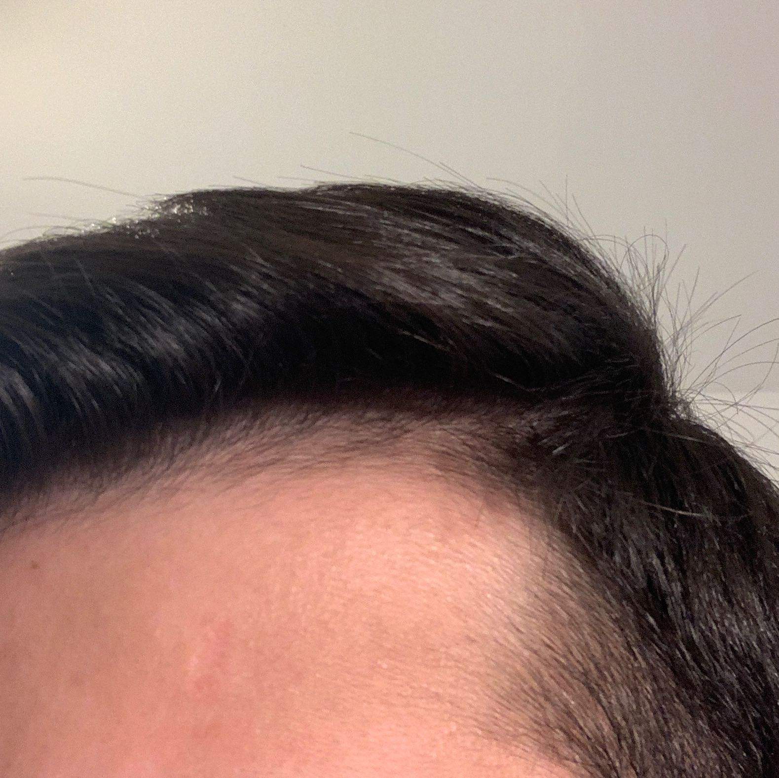 Was Hilft Gegen Geheimratsecken Gesundheit Und Medizin Hair Was Hilft Gegen Geheimratsecken Gesundheit Und Medizin Hair