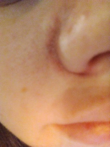 Was Hilft Gegen Rotungen An Der Nase Und Backen Beauty Haut Pickel