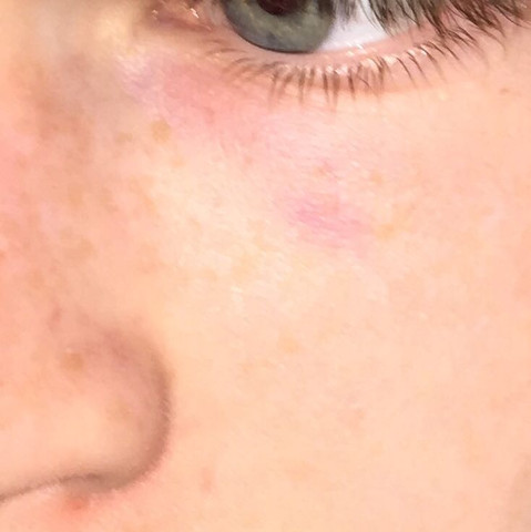 Was Hilft Gegen Rot Blaues Auge Gesundheit Frauen Manner Was Hilft Gegen Rot Blaues Auge Gesundheit Frauen Manner