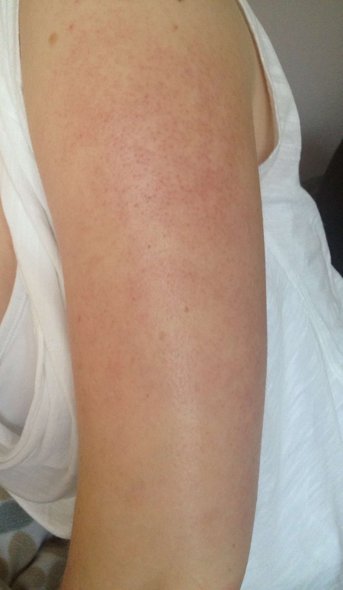 Was Hilft Gegen Rote Punktchen Am Oberarm Haut Aussehen Hautpflege