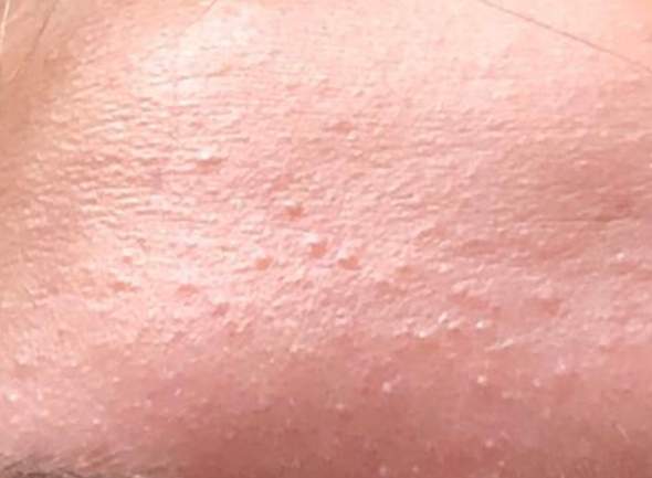 Was hilft gegen solche Pickel? (Gesundheit und Medizin, Beauty, Haut)