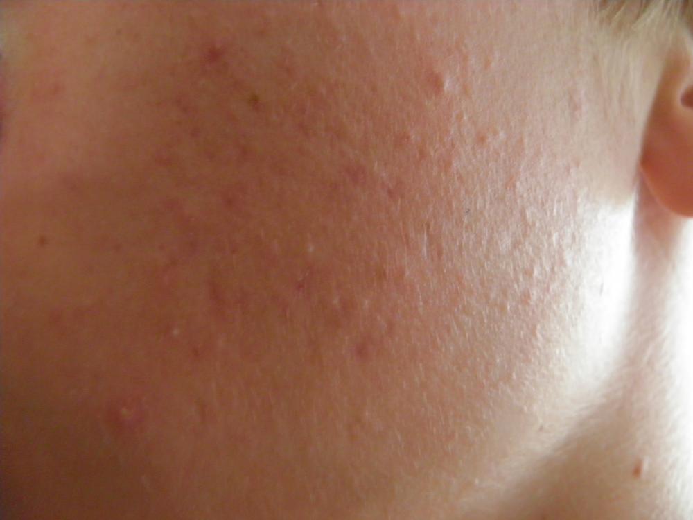 15+ Kleiner Pickel Auf Der Zungenspitze Pictures