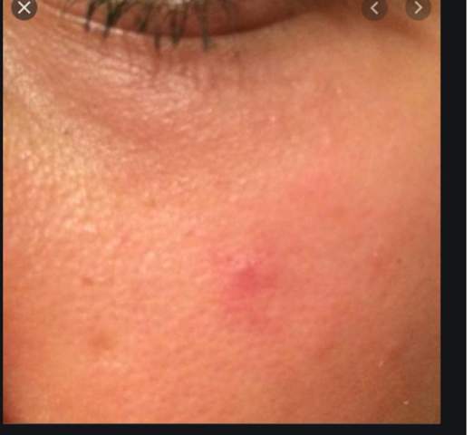Was Hilft Gut Gegen Pickel Unter Dem Auge Und Auf Der Nase Haut