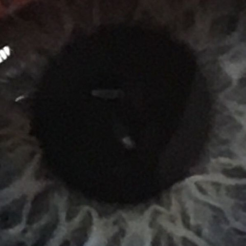 Weißer Punkt in meinem Auge - (Schmerzen, Augen, Pupille)