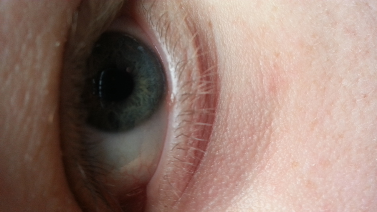 Was is das Rote auf dem unteren Augenlid (Medizin, Augen)