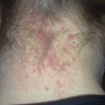 pickel haaransatz nacken pickel haaransatz nacken