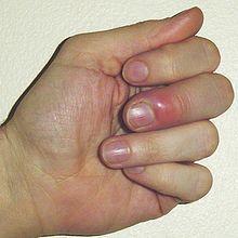 joa - (Entzündung, Verletzung, Finger)