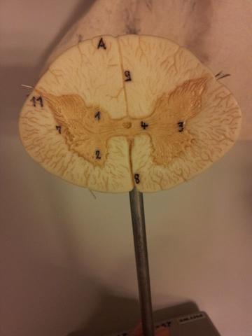 Was ist das ? Hat etwas mit der Wirbelsäule zu tun (Skoliose) - (Bilder, Biologie, Modellbau)