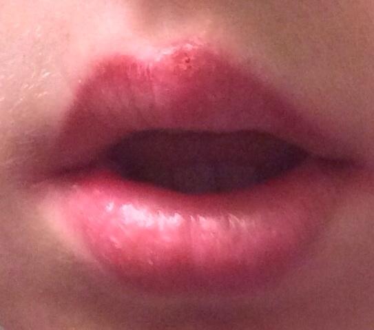 Was ist das? Ein Bläschen auf der Lippe (Pickel, Herpes, Infektion)