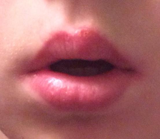 Was ist das? Ein Bläschen auf der Lippe (Pickel, Herpes, Infektion)