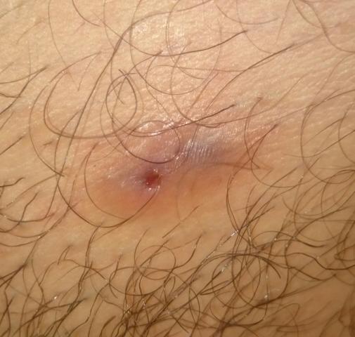 ein eingewachsenes haar haare