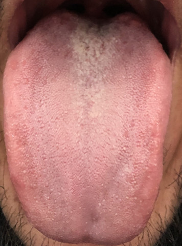 Was Ist Das Ein Zungenpilz Gesundheit Was Ist Das Ein Zungenpilz Gesundheit