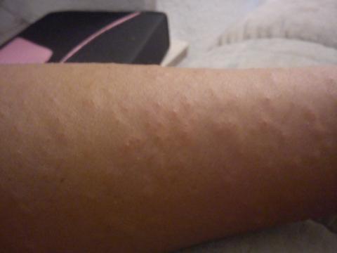 Was Ist Das Juckreiz Blaschen Am Arm Gesundheit Haut Rot Was Ist Das Juckreiz Blaschen Am Arm Gesundheit Haut Rot