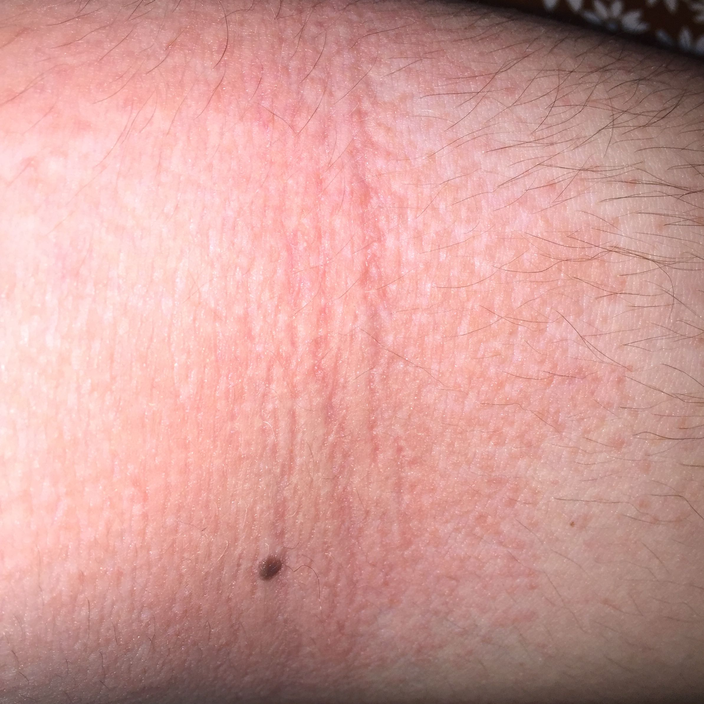 Was ist das? Trockene Haut? Allergie? (Arzt, Juckreiz)