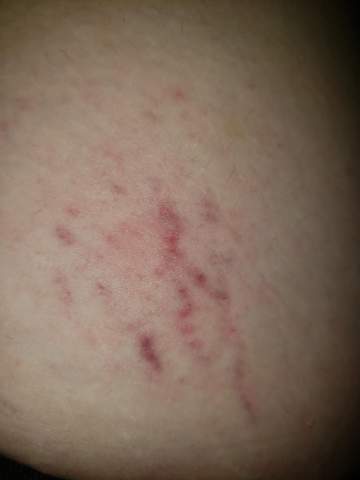 Was Ist Das Dehnungsstreifen Bindegewebsschwache