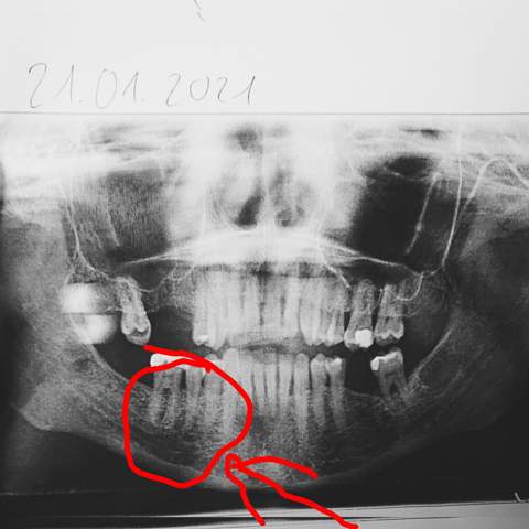 Grau wird wurzelbehandelter zahn Toter Zahn