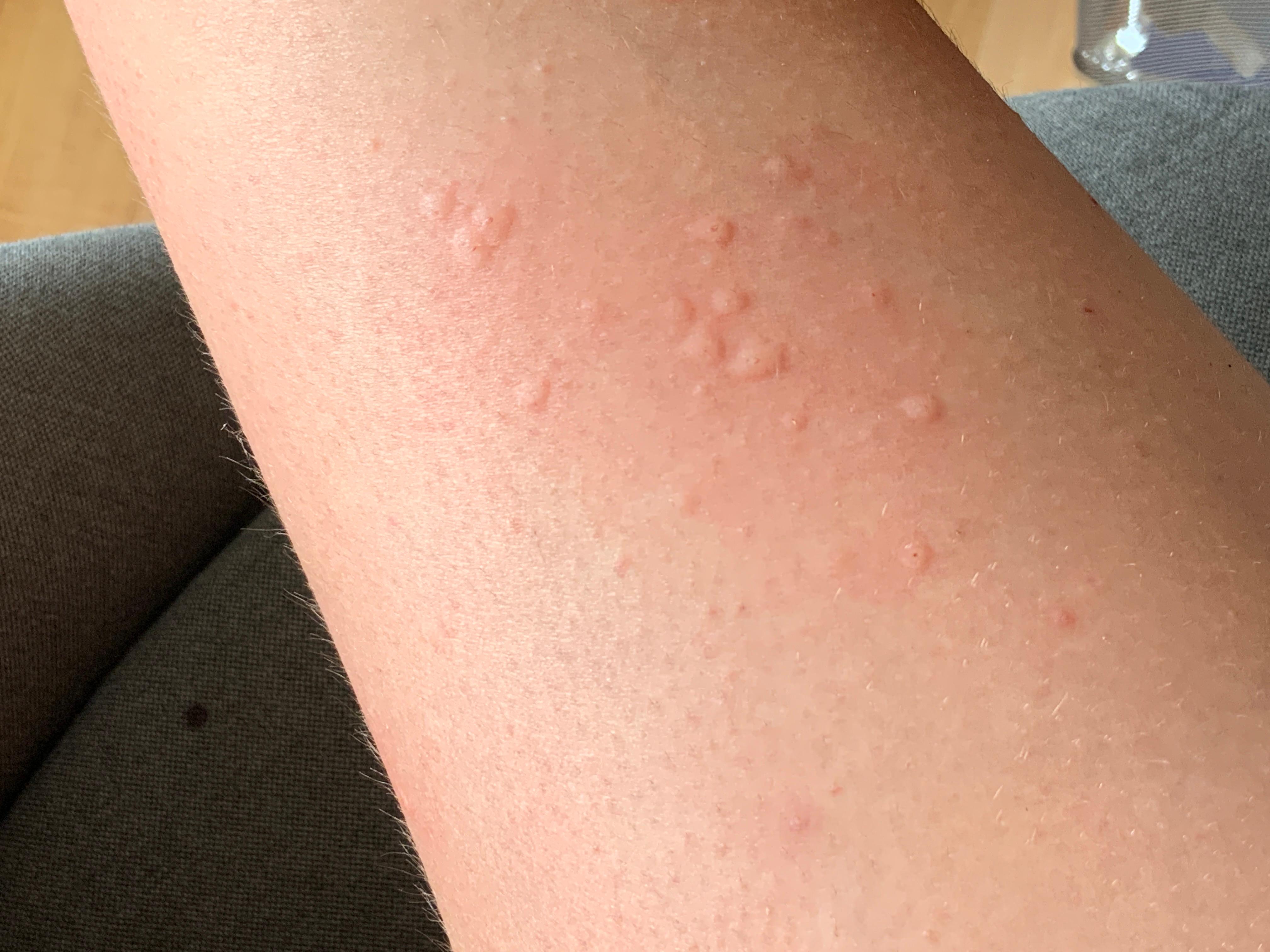 Was ist das? (Haut, Oberschenkel)