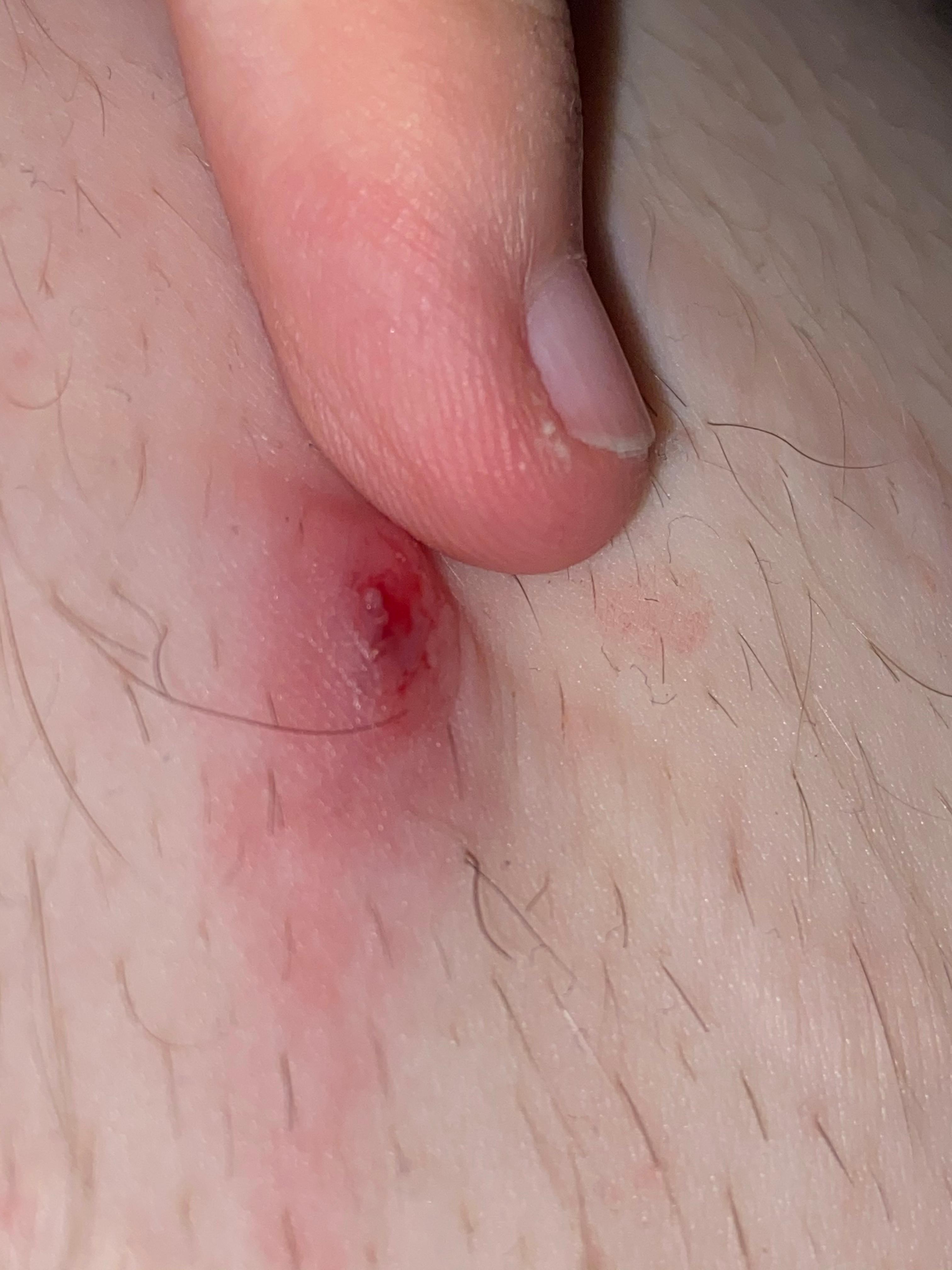 abszess eingewachsenes haar