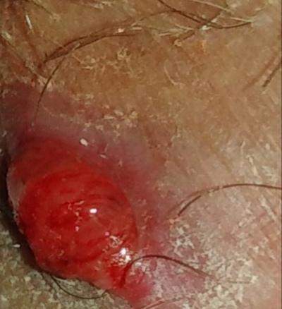 Was Ist Das Abzess Intimbereich Eiterblase Eiterbeule Was Ist Das Abzess Intimbereich Eiterblase Eiterbeule