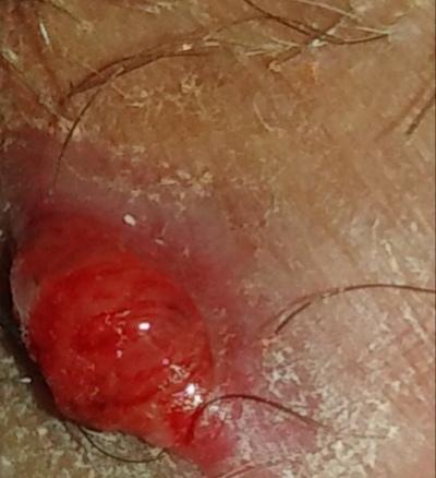 Was Ist Das Abzess Intimbereich Eiterblase Eiterbeule Was Ist Das Abzess Intimbereich Eiterblase Eiterbeule