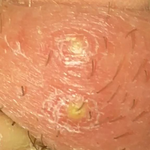 Was Ist Das Achtung Eklig Skandals Gesundheit Und Medizin Pickel Intimbereich Was Ist Das Achtung Eklig Skandals Gesundheit Und Medizin Pickel Intimbereich