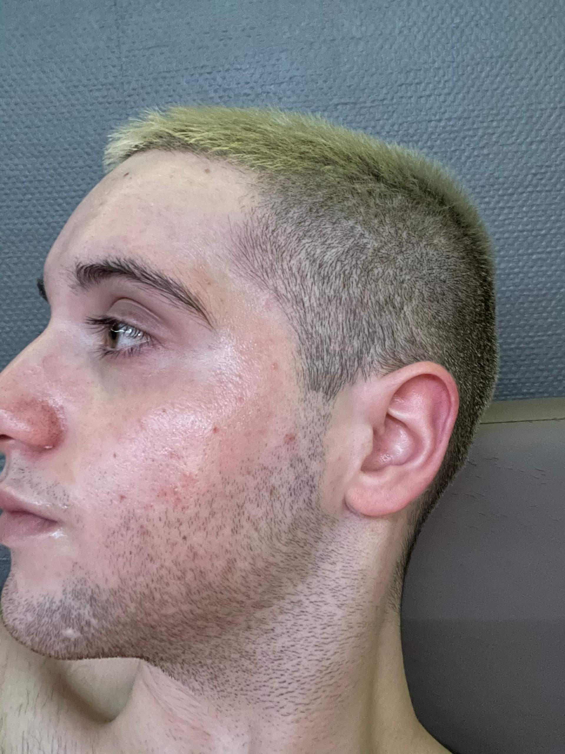 Was Ist Das? Akne? Geht Seit 2 Jahren Nicht Weg? (Gesundheit Und