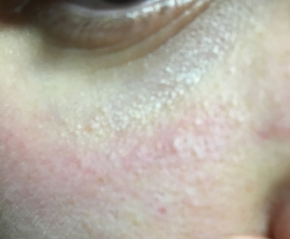 Was Ist Das Am Auge Pickel Punkte Wie Bekomme Ich Es Weg Augen Pflege