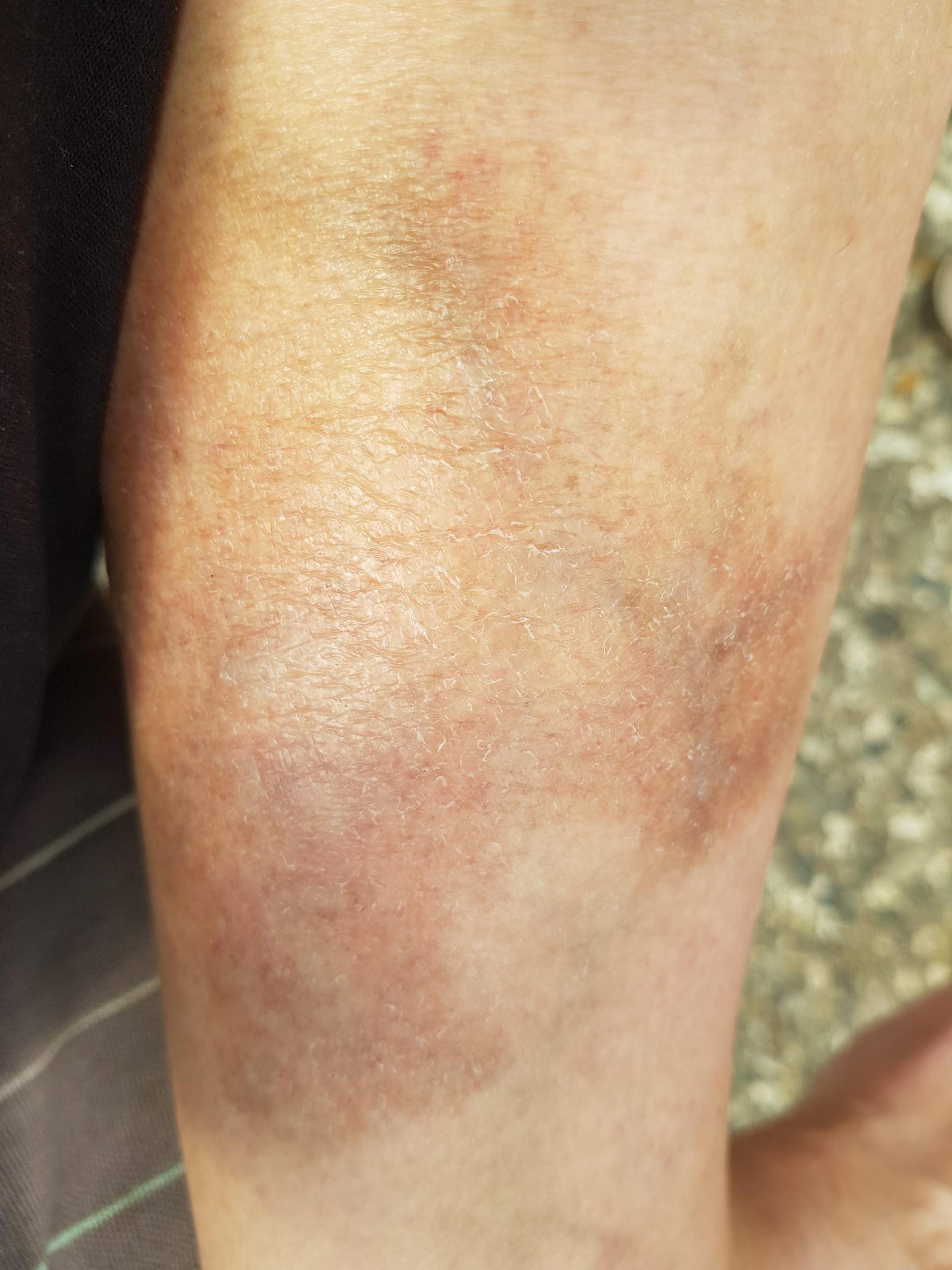 Was ist das am Bein? (Gesundheit und Medizin, Gesundheit, Beine)