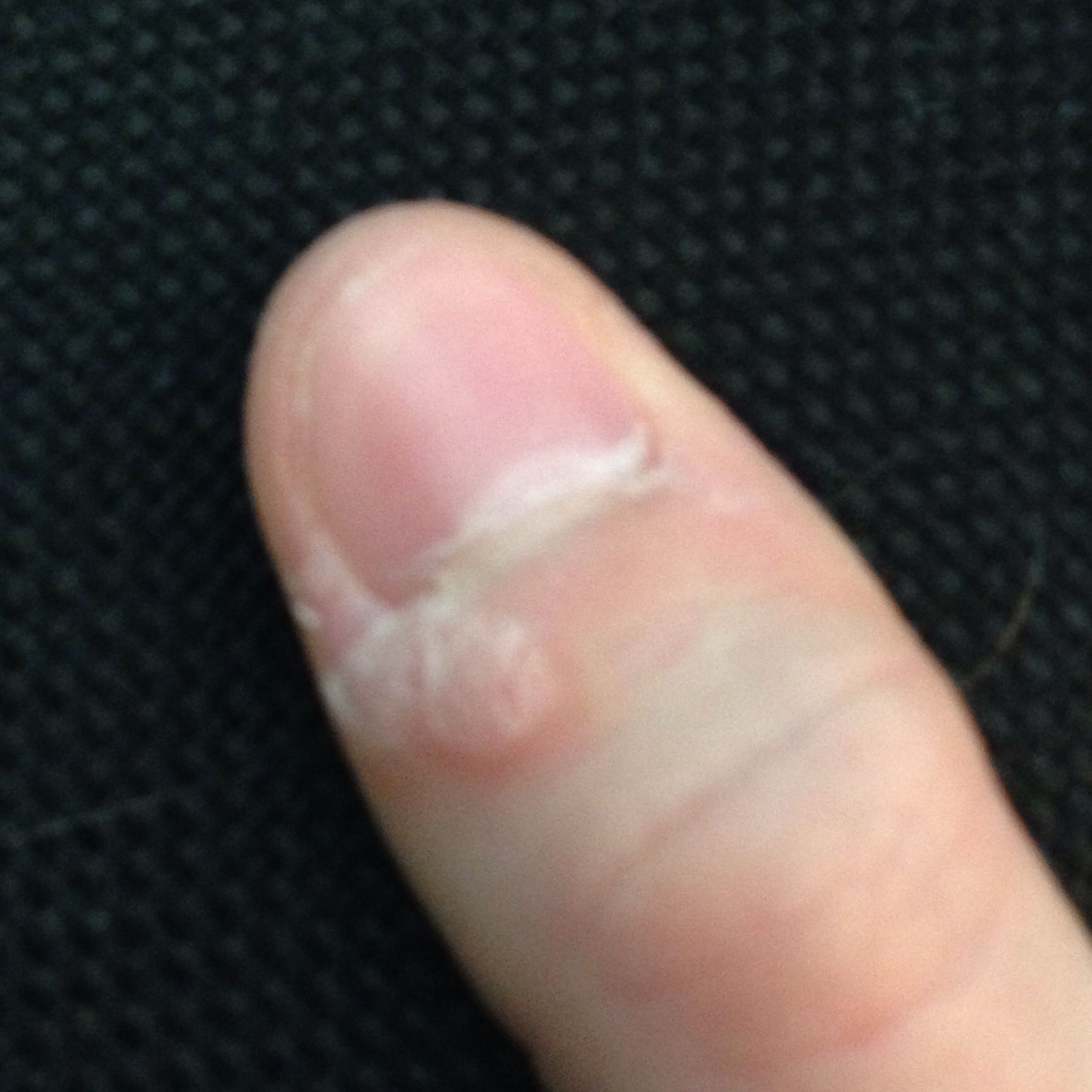 Wie Bekomme Ich Schrunden Am Daumen Weg Was ist das am daumen? (Arzt, Finger)