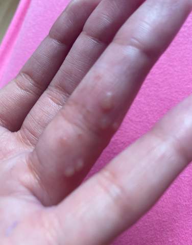 Was Ist Das Am Finger Gesundheit Und Medizin Gesundheit Blaeschen Was Ist Das Am Finger Gesundheit Und Medizin Gesundheit Blaeschen
