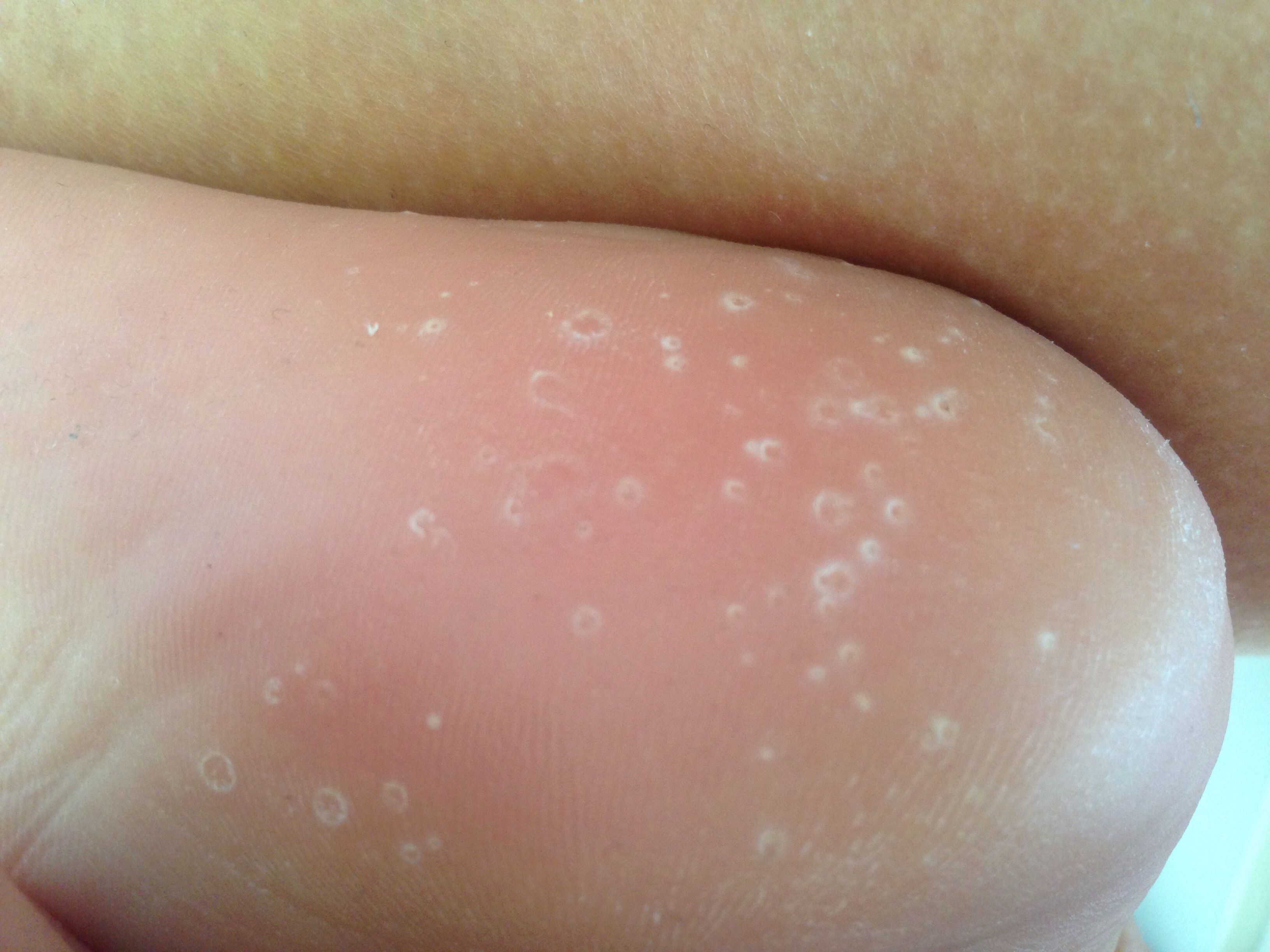 Was ist das am Fuß? (Bild unten) (Haut, Füße, Orthopäde)