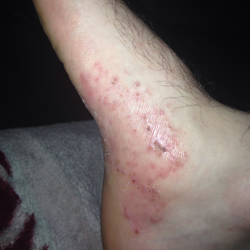 Was ist das am Fuss? (Juckt) (Arzt, Haut, Füße) Was ist das am Fuss? (Juckt) (Arzt, Haut, Füße)