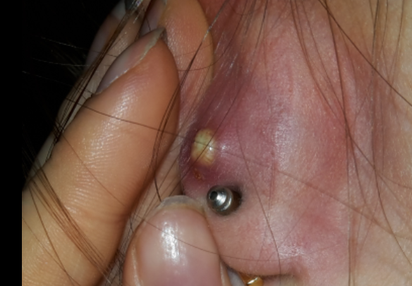 Was Ist Das Am Ohr Meiner Bff Medizin