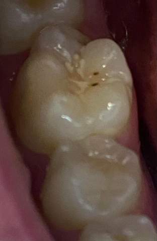 Was Ist Das Am Zahn Fur Ein Punkt Zahne Zahnarzt Zahnschmerzen Was Ist Das Am Zahn Fur Ein Punkt Zahne Zahnarzt Zahnschmerzen